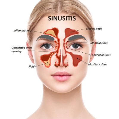 How to Manage Sinusitis Naturally - Natural Medicine World